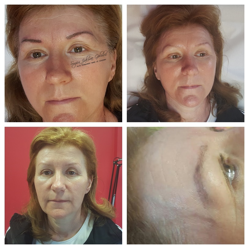 Non Laser Pigment Removal - jedno uklanjanje